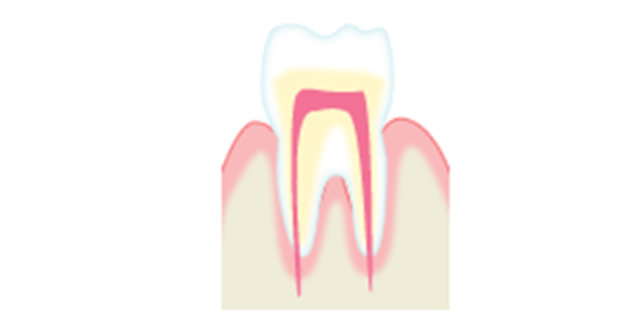 虫歯のメカニズムC1