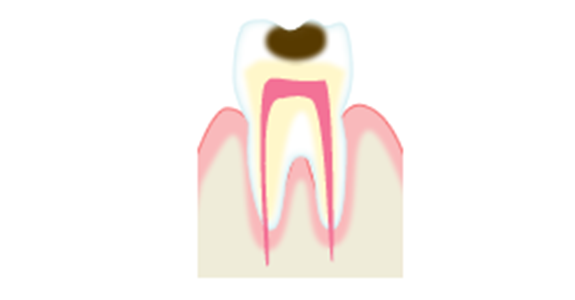 虫歯のメカニズムC2