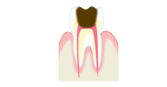 虫歯のメカニズムC3
