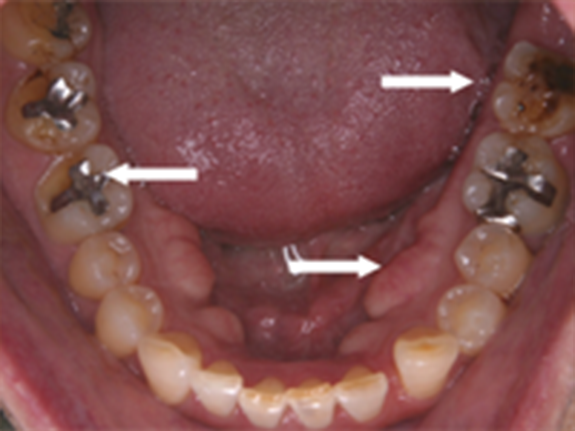 歯ぎしりによる変化
